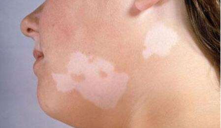 Vitiligo treatment