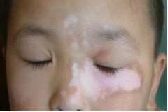 The Causes for Children Vitiligo