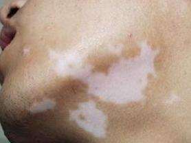 Vitiligo symptoms