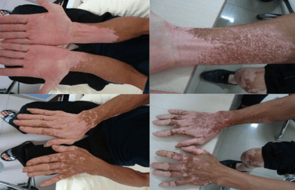 How to Prevent Vitiligo on Hands