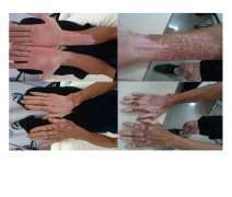 How to Prevent Vitiligo on Hands