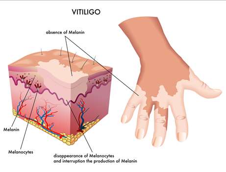 Vitiligo Treatment Theory 