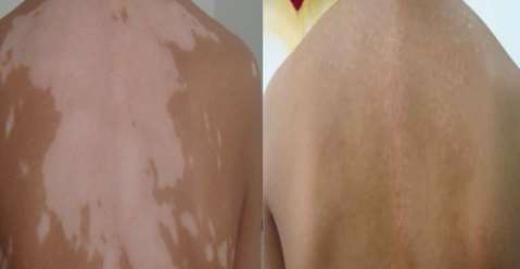 A 27-Year Vitiligo Recovery Case,Vitiligo