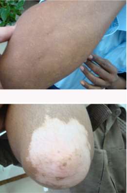 what are causes of vitiligo