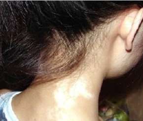 vitiligo on neck