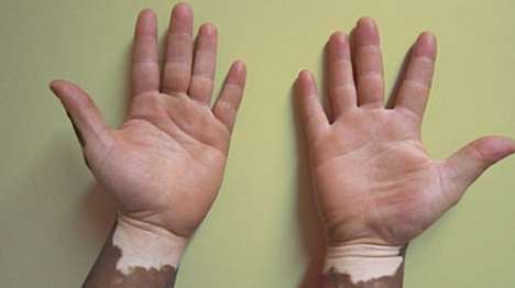 Chinese UM-D Vitiligo Therapy,Vitiligo 