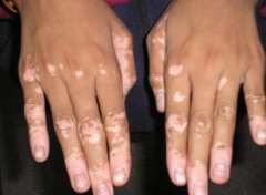 Why vitiligo usually appears on limb parts?