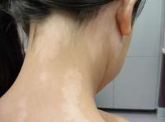 How to treat vitiligo in the neck?