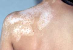 Causes and Treatments for Vitiligo on Back