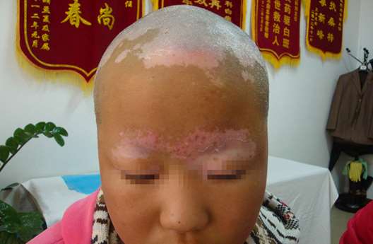 Teenager vitiligo patients