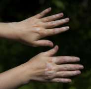 Why vitiligo usually appears on hands and h