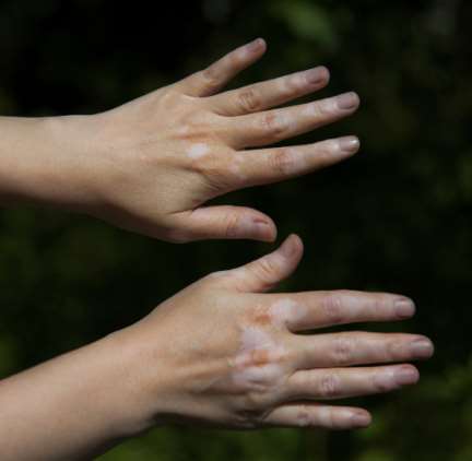 Vitiligo on hands