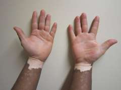 What to do if children get vitiligo?