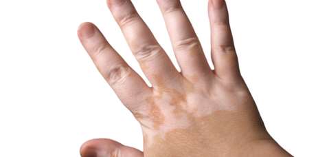 Early vitiligo symptom