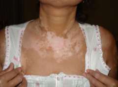 How to treat the vitiligo on children’s n