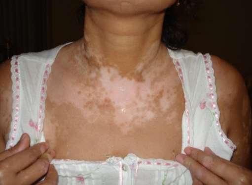 vitiligo on children neck