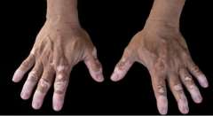 What should elderly vitiligo patients pay a