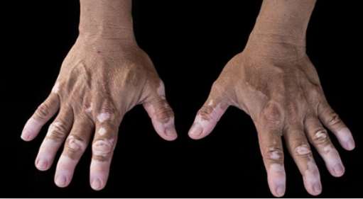 elderly vitiligo patients