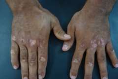 Preventions and Complications of Vitiligo