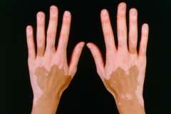 How to diagnose the onset of vitiligo?