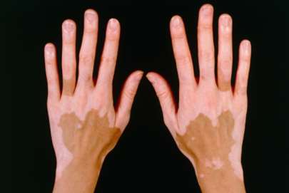 vitiligo diagnosis