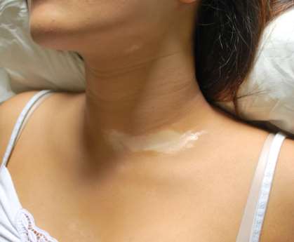 Vitiligo Causes from Different Aspects,Vitiligo 