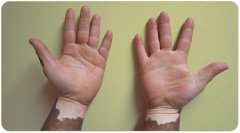 Is vitiligo treatment therapy different for