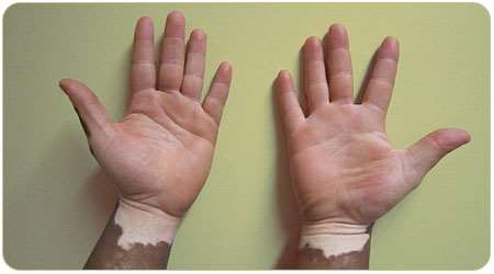 vitiligo treatment