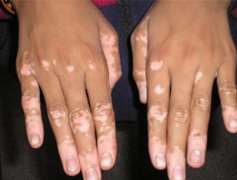 The main clinical symptoms of vitiligo