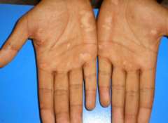 What’s the influence of vitiligo on human