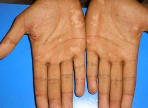 vitiligo symptom