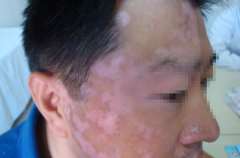 What is the damage of men vitiligo patients