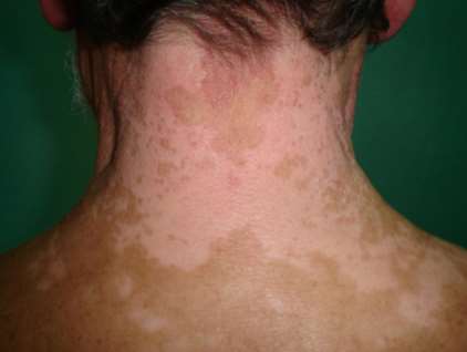 vitiligo on neck