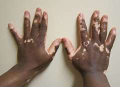 Can vitiligo on fingers be Treated?