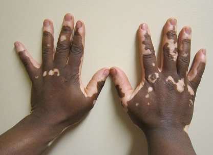 vitiligo on fingers