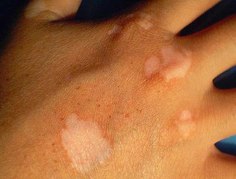 Can Placenta Extractive Be Used for Vitiligo Therapy,Vitiligo