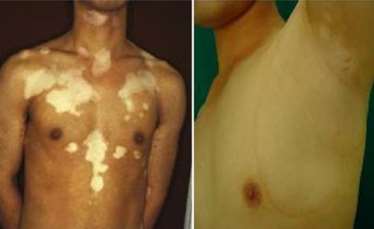 men vitiligo patients