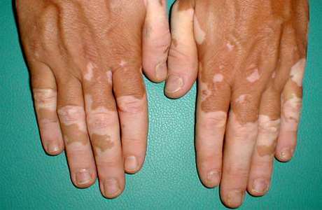 acral vitiligo 