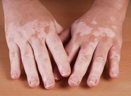 vitiligo symptoms