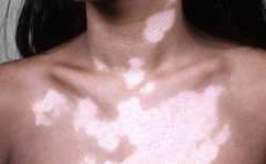 How to Check the Effects of Vitiligo Treatm