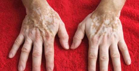 vitiligo symptom