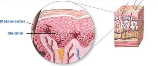 vitiligo inheritance