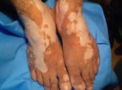 What should vitiligo patients do in differe