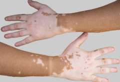 What is the damages of vitiligo?