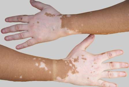 vitiligo symptom