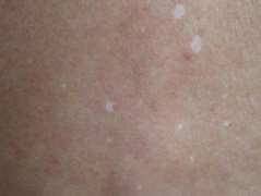 What are the causes of vitiligo