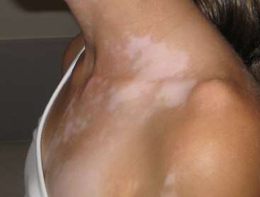 Vitiligo Features and Causes,Vitiligo