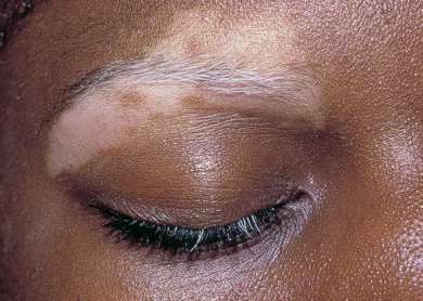 women vitiligo patients