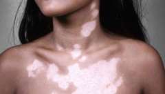 What should vitiligo patients pay attention