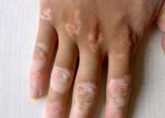 What is the symptom of development vitiligo